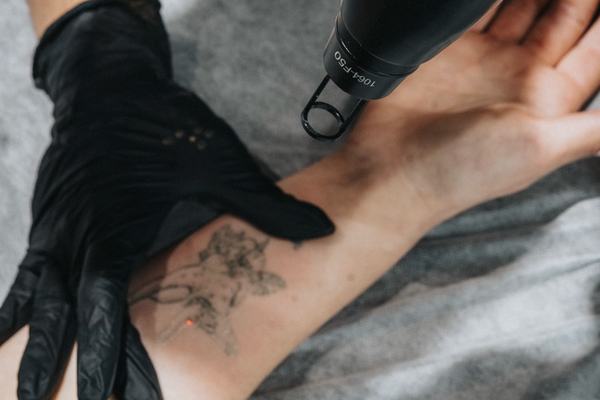 tatuiruotės pigmento reakcija į lazerio poveikį procedūros metu