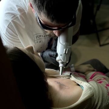 Lazerinis tatuiruotės šviesinimas procedūros metu