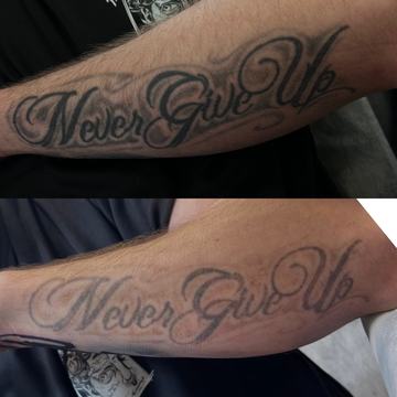 lazerio poveikis tatuiruotės pigmentui odoje