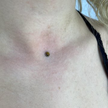 Microdermal13
