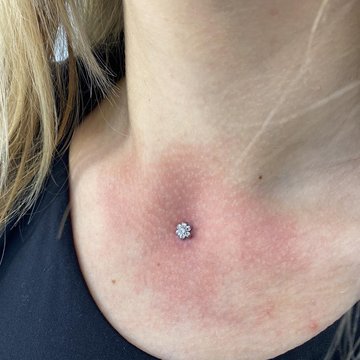 Microdermal17